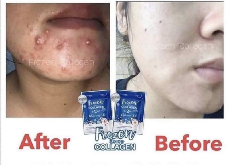 Frozen Collagen 2 in 1 Whitening