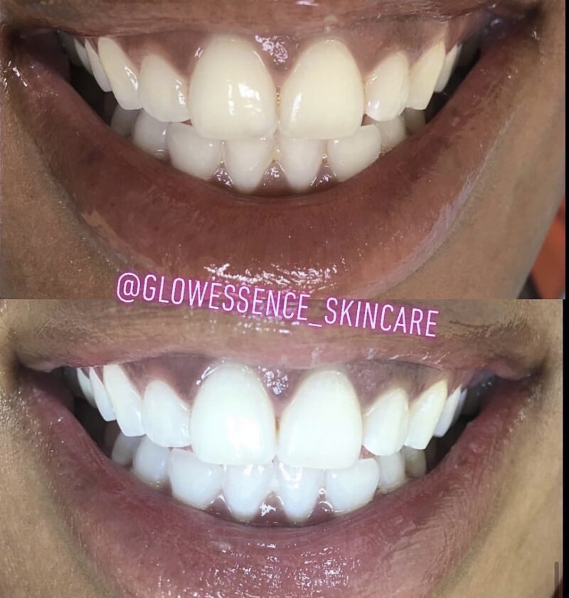 MIRACLE TEETH WHITENING POWDER
