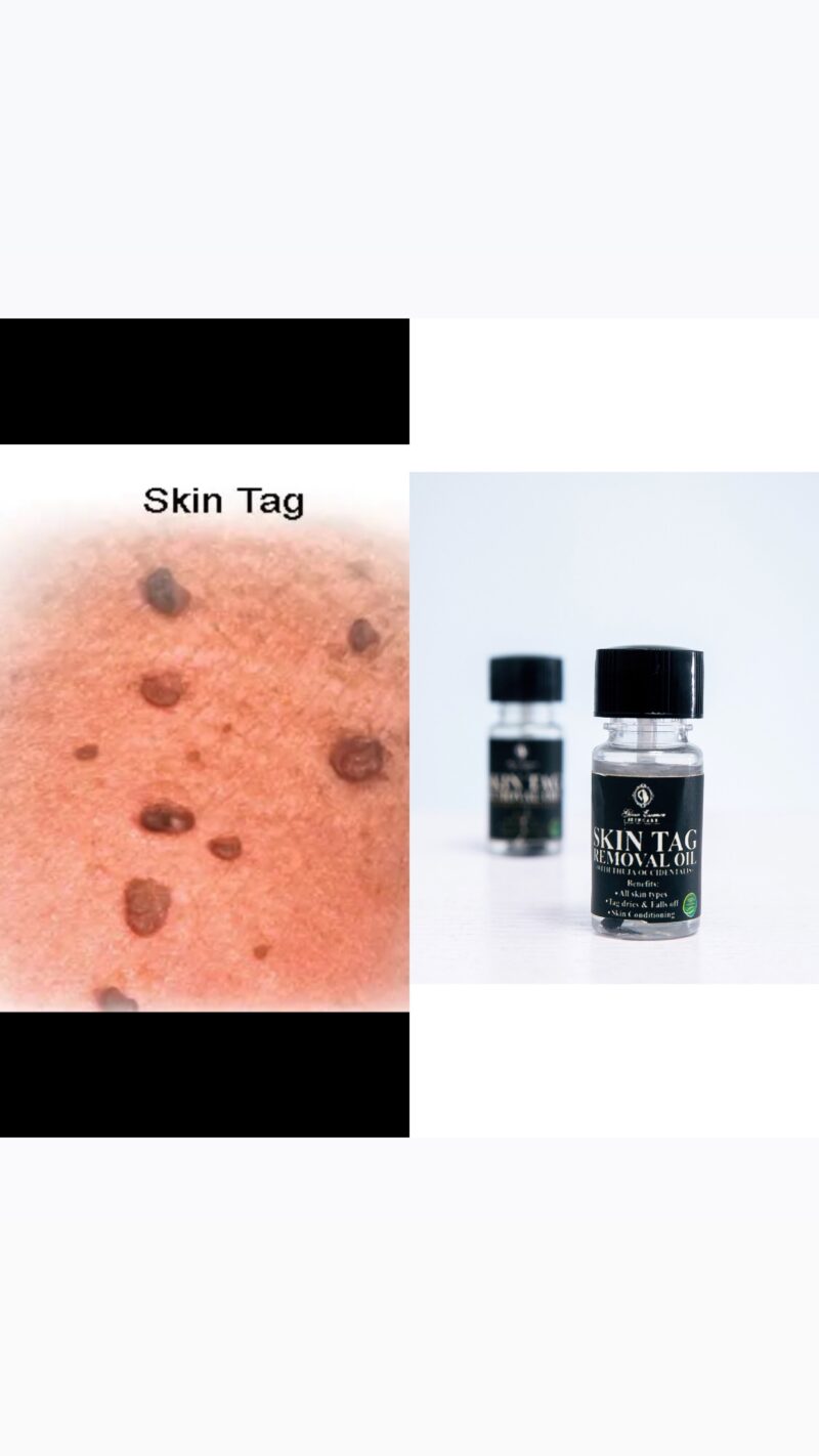 SKIN TAG REMOVAL OIL WITH “Thuja oocidentalis”🍃.