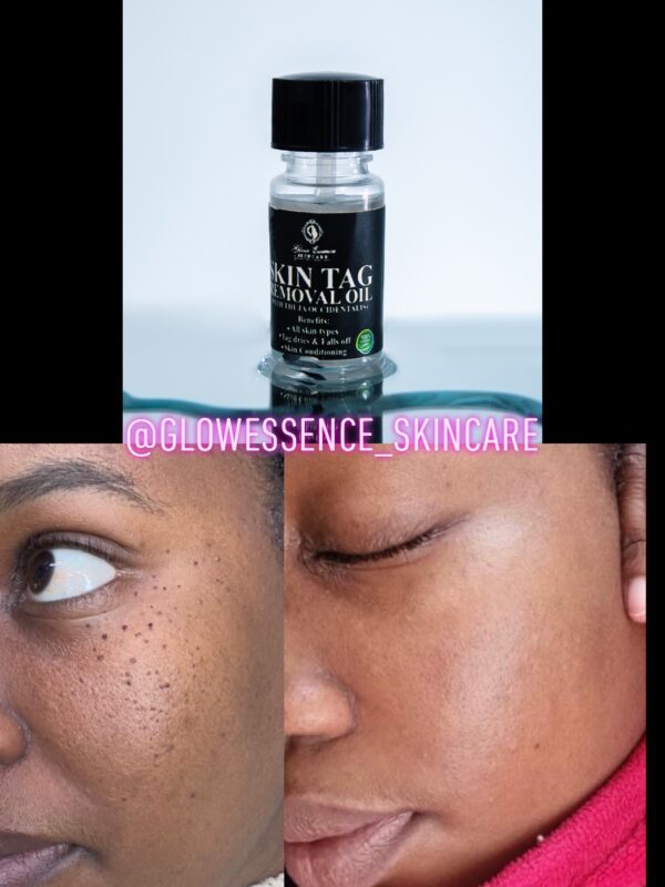 SKIN TAG REMOVAL OIL WITH “Thuja oocidentalis”🍃.