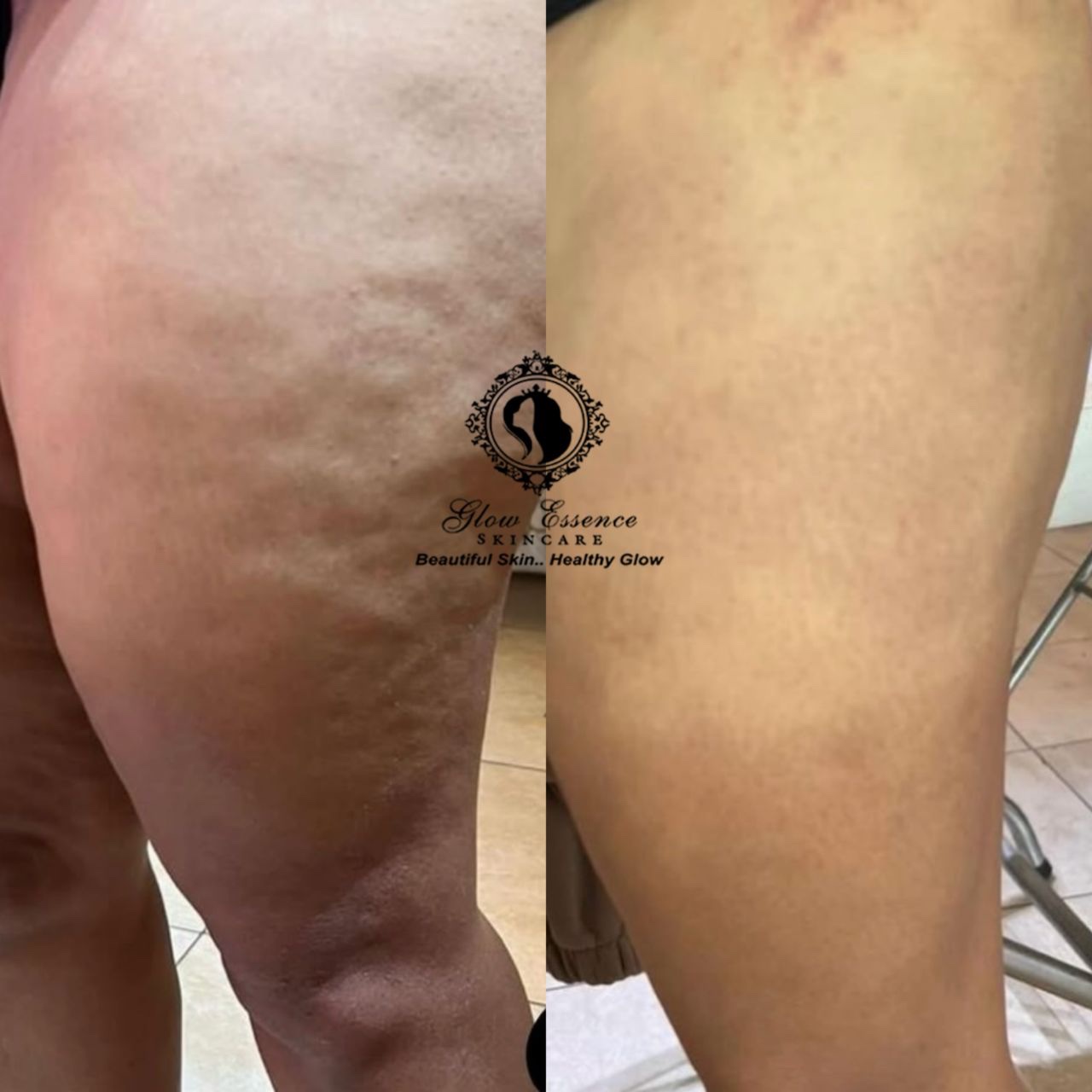 Severe Anti-Cellulite Package (Collagen+Stem Cell Infused) with Coffee scrub