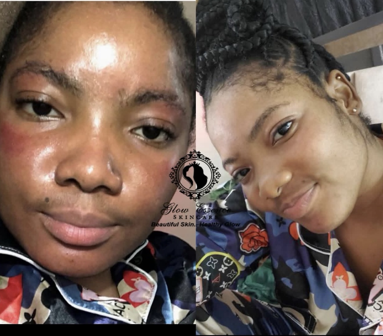 FACE REDNESS COMBO✨