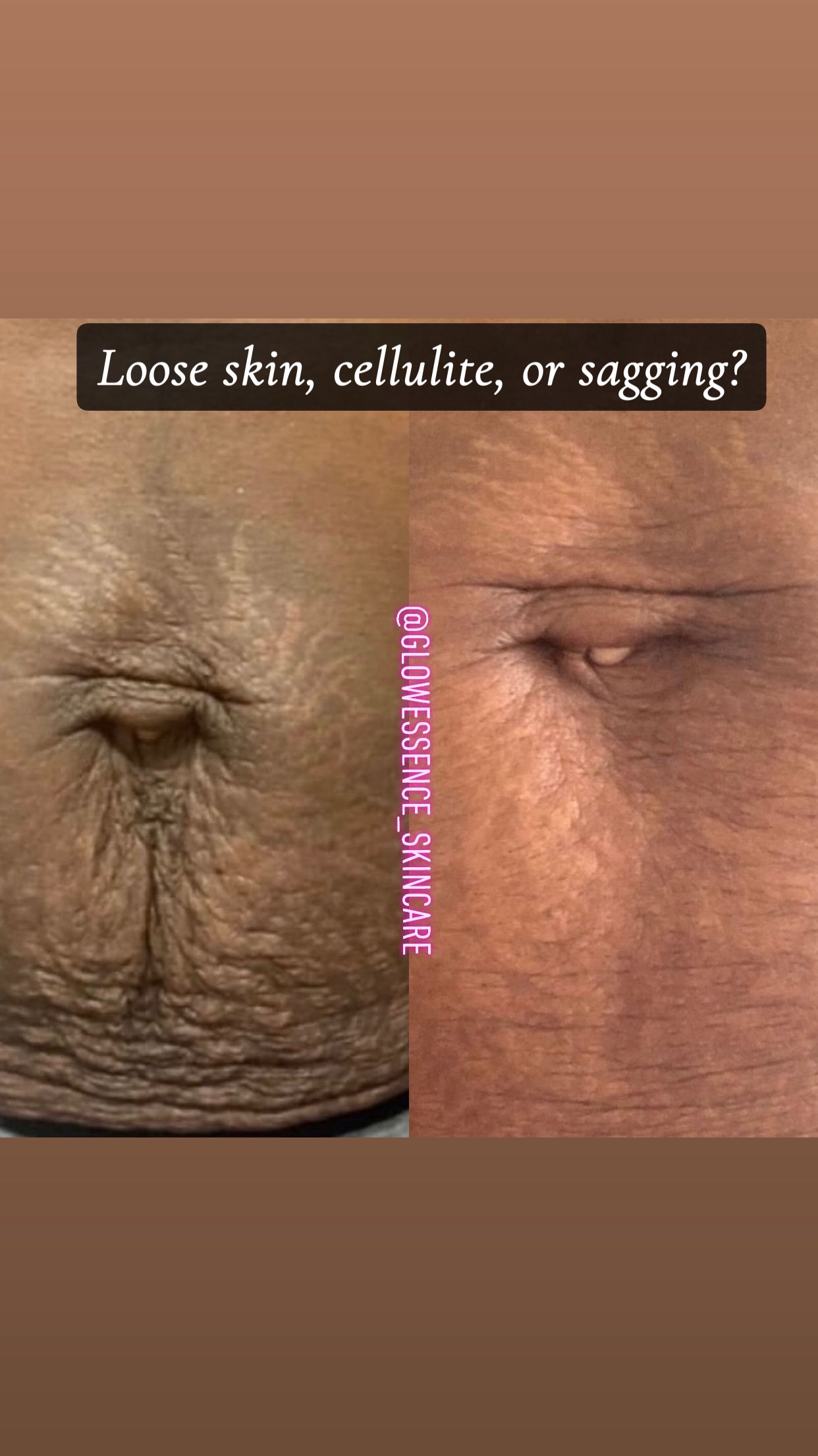 Severe Anti-Cellulite Package (Collagen+Stem Cell Infused) with Coffee scrub