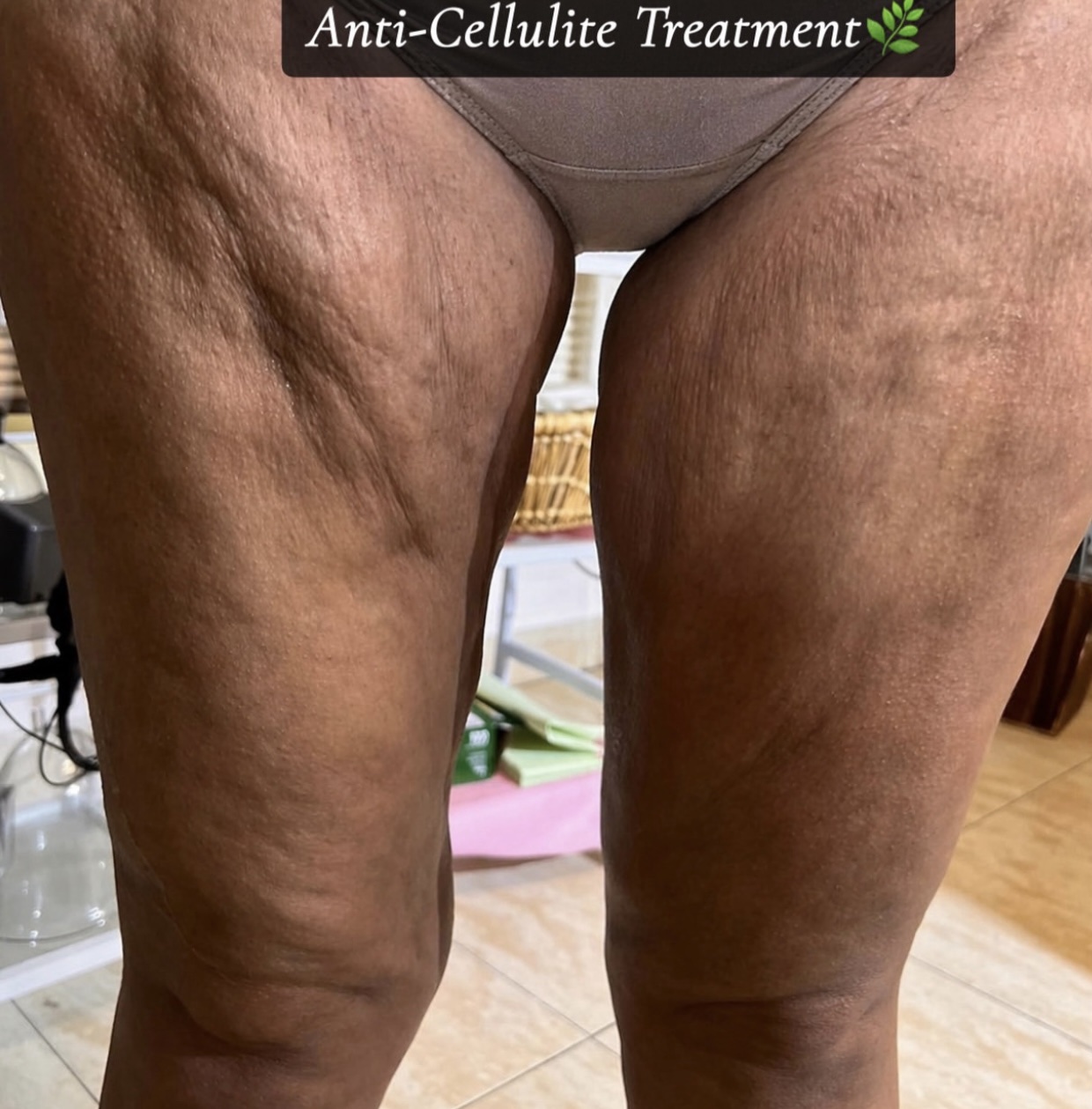 Severe Anti-Cellulite Package (Collagen+Stem Cell Infused) with Coffee scrub
