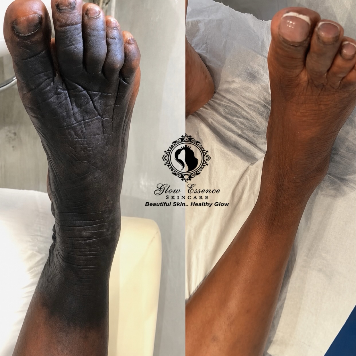 DARK HAND/ FEET COMBO